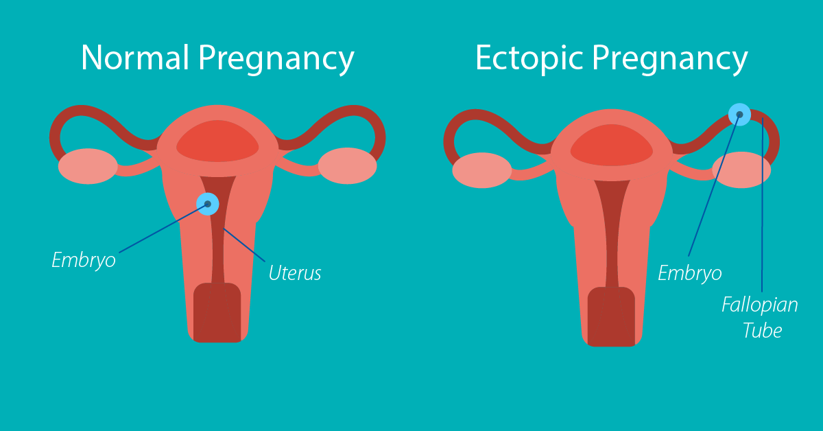 how do i know if i have an ectopic pregnancy